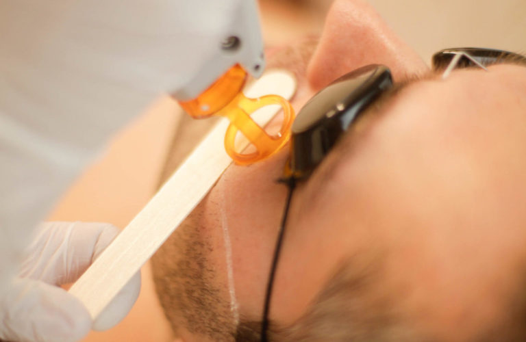 What are the various laser options for permanent hair removal?