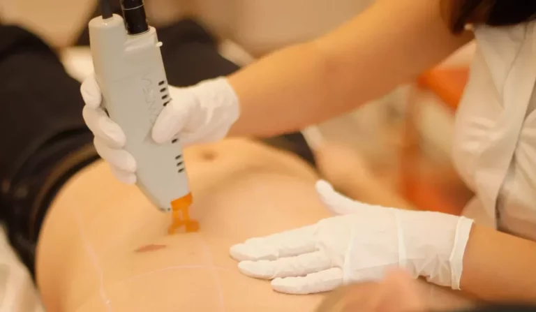 Hoe werkt de Candela Alexandrite laser?