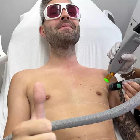 Épilation laser du dos pour hommes, une solution efficace et durable.