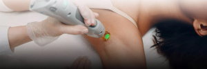 Promotion Épilation Laser Aisselles Epilsoft